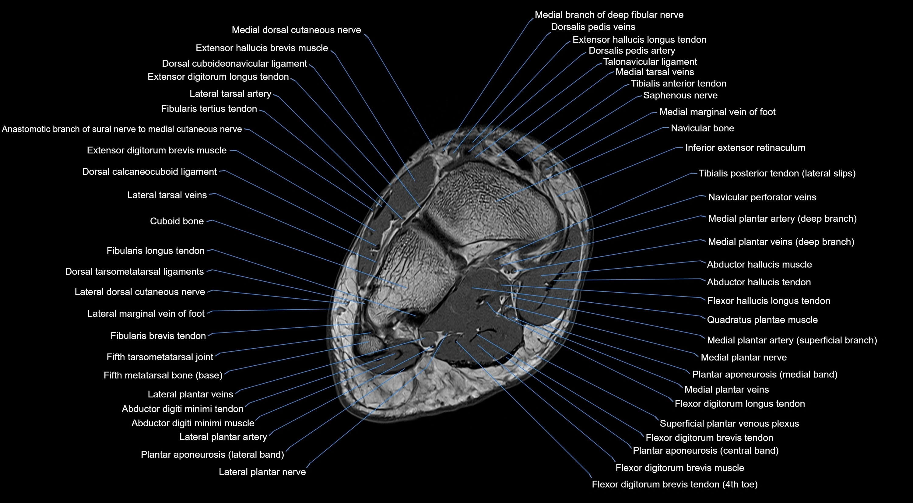 MRI mid foot coronal ligaments cross sectional anatomy 3T  radiology  image-img-00001-00028.webp